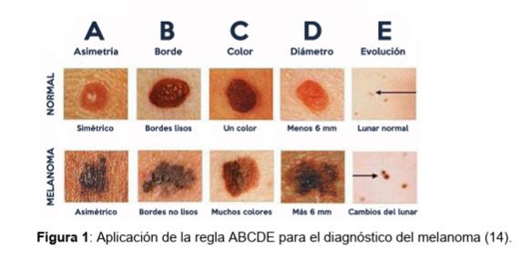 Aplicación de la regla ABCDE